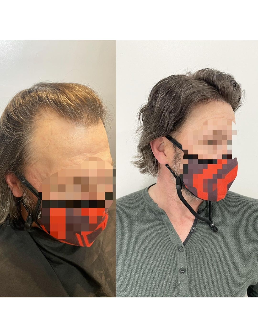 men hair system